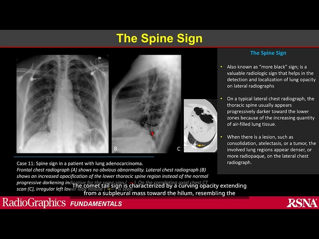 Classic Signs on Chest Radiographs: A Primer for Diagnostic Precision | AI Chavelle™