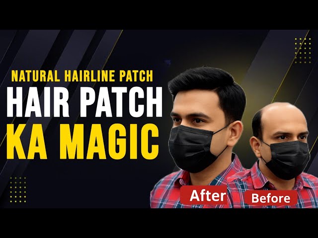 Baal Wapas Paayein 1 Ghante Mein | Rizy Hair Solution | Best Hair Patch Centre | 9599858612