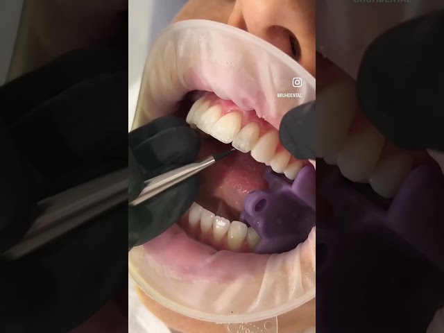Composite bonding in action 🔥 #compositebonding