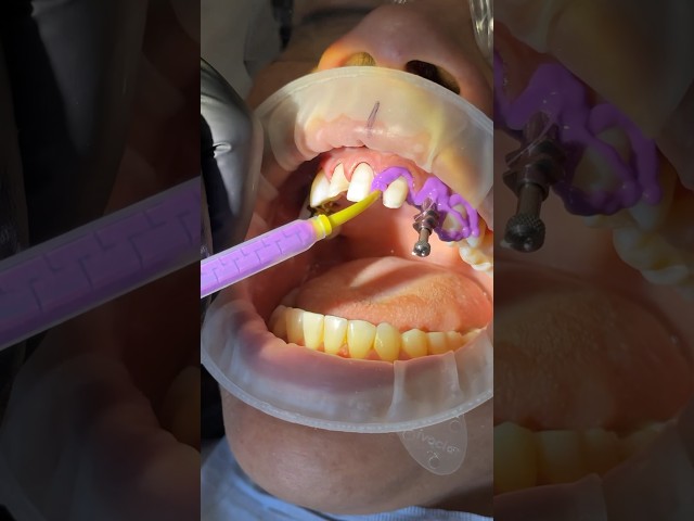 Open Tray Impression with Panasil X-Light and Tray Soft Heavy (@kettenbachusa) #dentist #impression