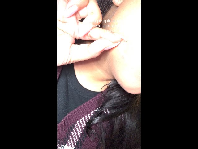 Pimple Patches for the win!