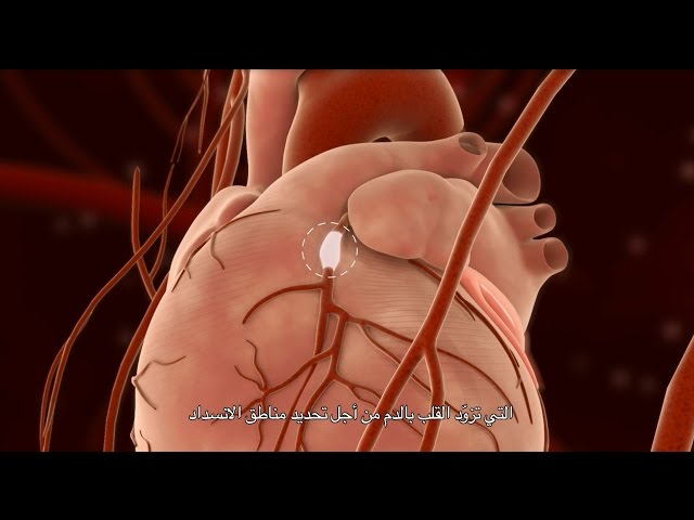 Percutaneous Coronary Intervention (PCI)