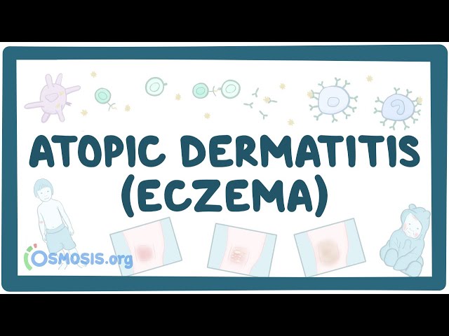 Atopic dermatitis (eczema) - causes, symptoms, diagnosis, treatment, pathology