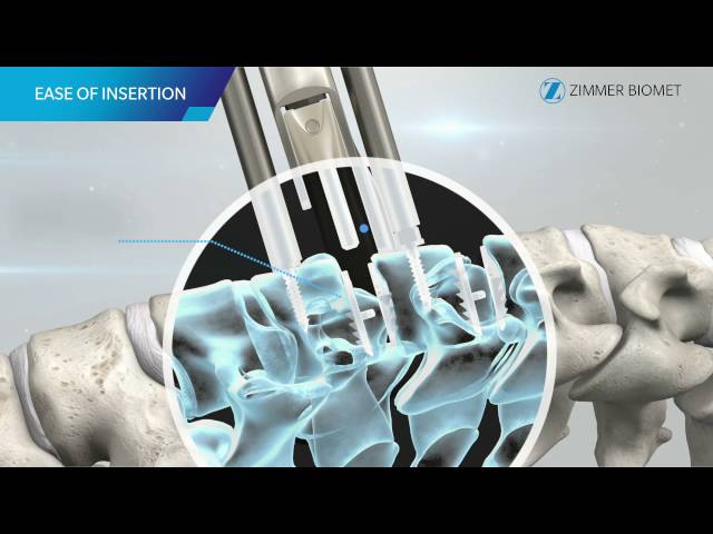 Mobi-C Cervical Disc