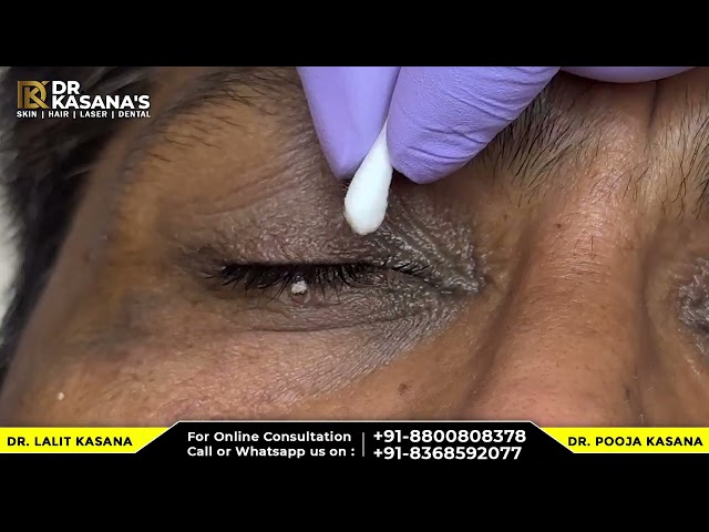Milia Removal Treatment with RF technology By Dr Lalit Kasana #blackheads