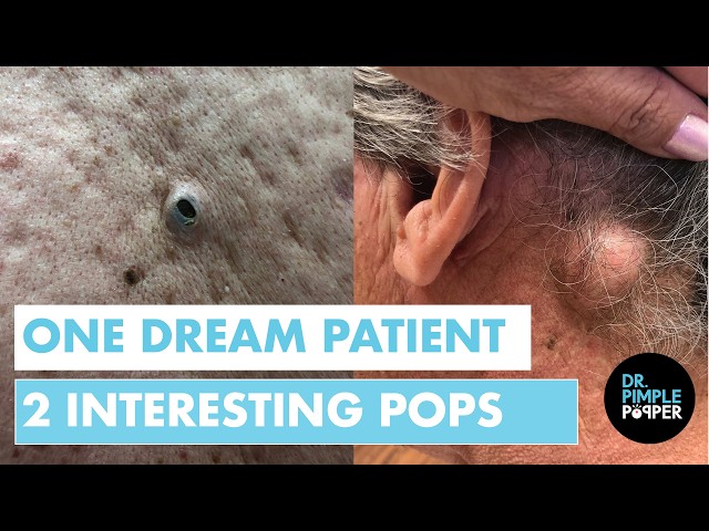 A Dream Patient | Dr. Pimple Popper Takes on Two Interesting Pops