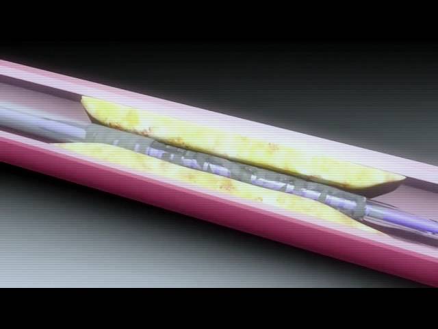Novel Resorbable Stent Improves Cardiac Care