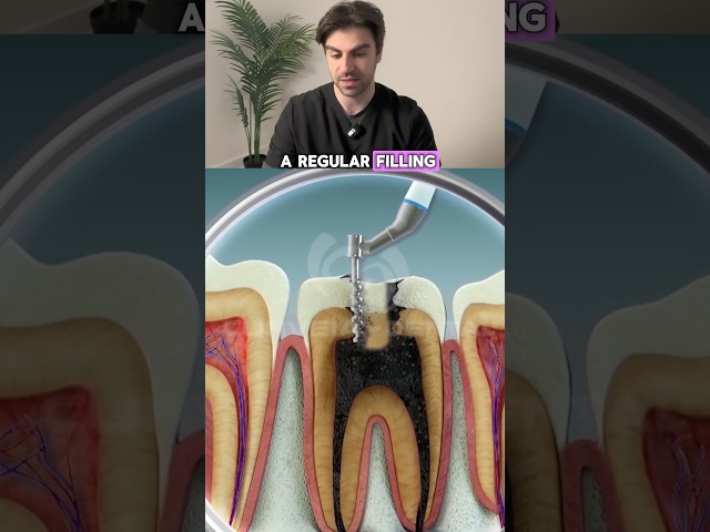 Root Canal Treatment Explained