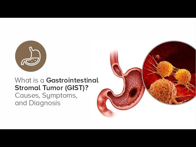 Gastrointestinal stromal tumor GIST; cancer arises from interstitial cells of Cajal