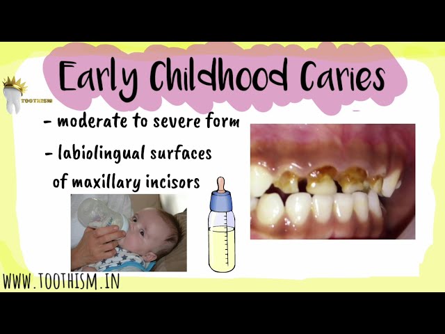 EARLY CHILDHOOD CARIES | Types of ECC | Prevention Levels, Management | ECC vs RAMPANT CARIES