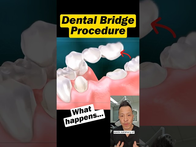 Missing a Tooth? Here’s How a Dental Bridge Is Done #dentallan #dentist #shorts