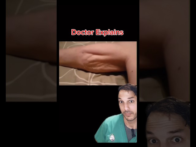 The mother of all muscle cramps #muscle #spasm #cramp #medicalstudent #doctor