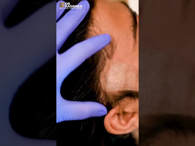 How to remove birthmarks II Birthmark removal by laser therapy  Dr Lalit Kasana  Dermatologist