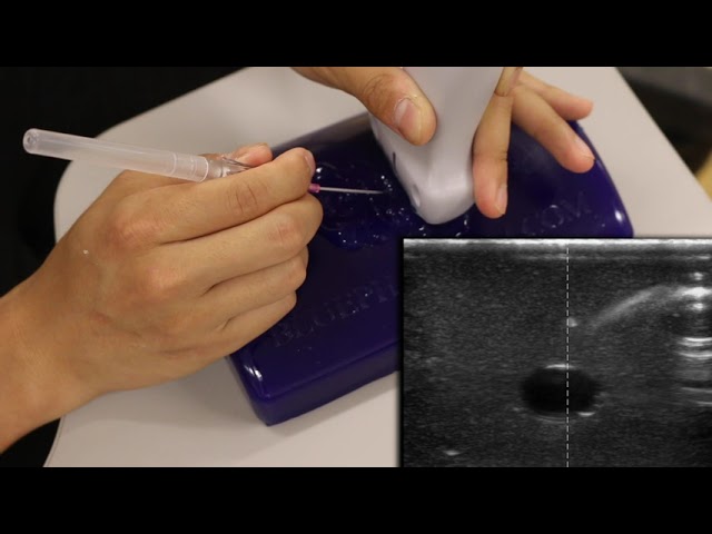 Ultrasound Guided Peripheral IV Placement