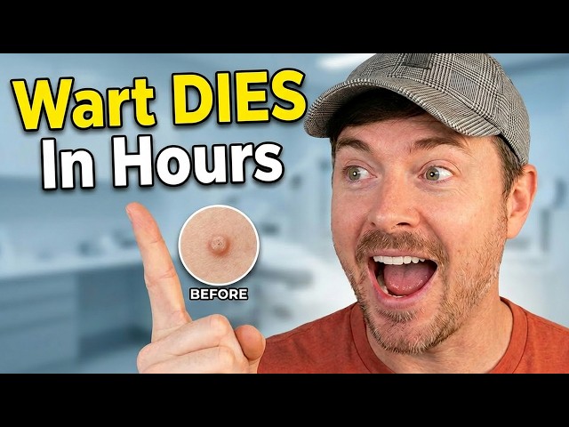 FASTEST WAY TO REMOVE WARTS | Painlessly and Safely | Chris Gibson