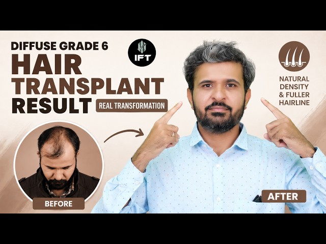Hair Transplant In Jaipur | Expert Guide & Cost of Hair Transplant In Jaipur
