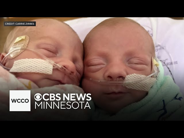 Minnesota woman gives birth to ultra rare mono mono twins