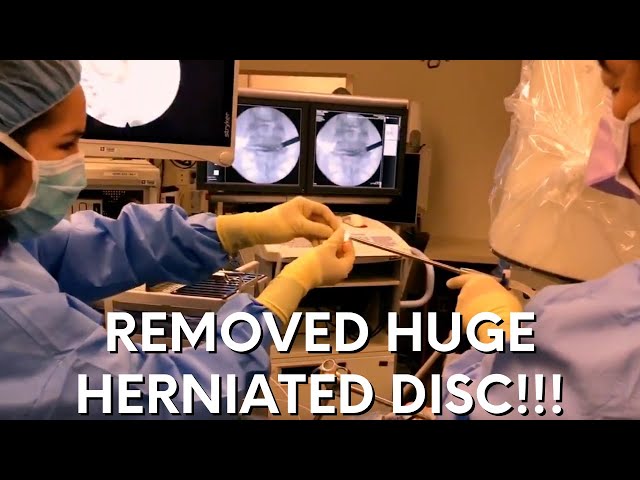 Huge Herniated disc at L4-5, L5-S1 removed with Laser Endoscopic Spine Surgery (LESS Procedure)