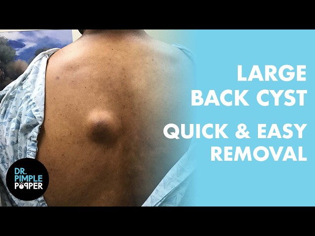 Dr. Pimple Popper vs. The Large Back Cyst | A Clean Removal from Start to Finish