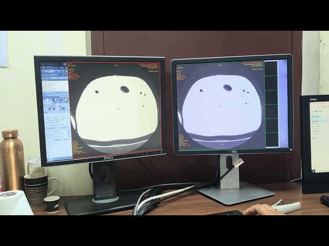 Hrct Chest. Post processing filming 