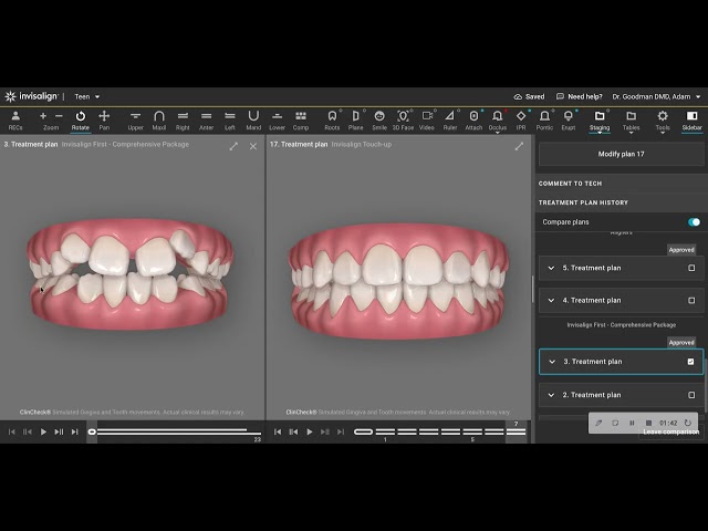 Skeletal Fixed Hyrax Palatal Expander vs. Dental Expansion with Invisalign First Aligners