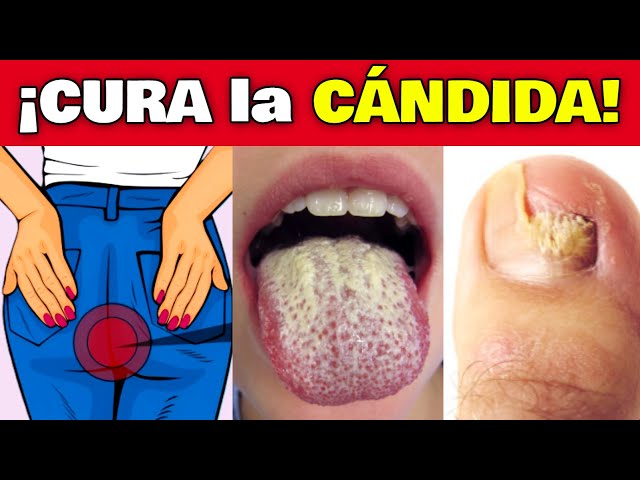 ✅ ¿CÓMO CURAR EL HONGO CÁNDIDA RÁPIDAMENTE? | La MEJOR FORMA de ELIMINAR la CÁNDIDA