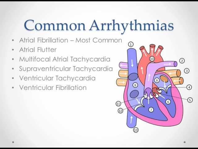 Common Arrhythmias - USMLE Step 2 Review