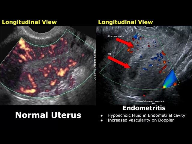 Uterus & Adnexa Ultrasound Normal Vs Pelvic Inflammatory Disease (PID) Images | Gynecological USG