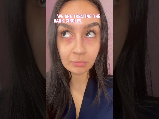 PRP For Dark Circles - Get Brighter Under Eyes