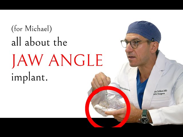 JAW ANGLE IMPLANTS | Why doesn't anyone talk about them?
