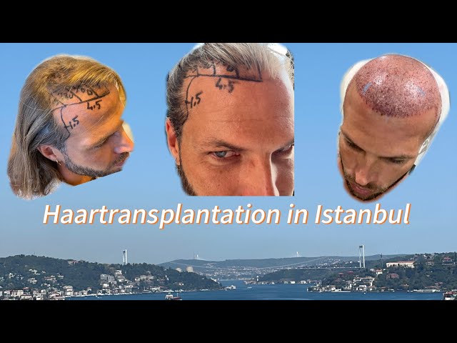 Hair transplant in Istanbul