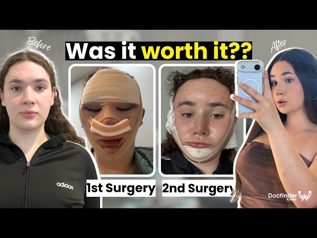 My Second Surgery in Korea - Was It Worth It?! (FFS in South Korea)