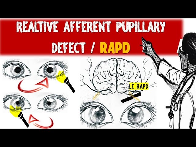 Understanding Relative Afferent Pupillary Defect (RAPD) & Marcus Gunn pupil