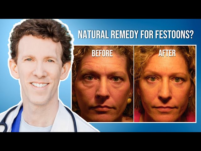 Is There a Natural Remedy for Malar Mounds and Festoons?