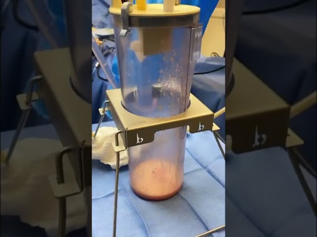 What Getting a BBL Surgery is REALLY Like! Gender Affirming Brazilian Butt Lift #bbl #plasticsurgery