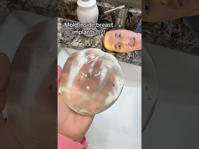 How Do You Get Mold Inside Breast Implants?