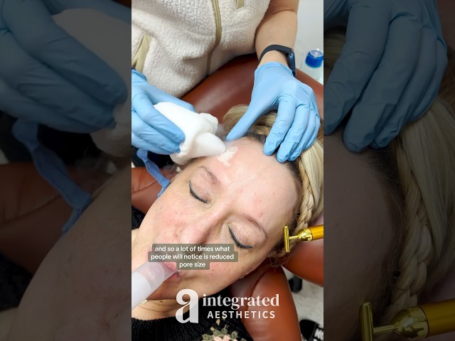 Peeling químico de profundidad media con CO2 sólido (hielo seco) y TCA | Estética Integral | Dr. ...