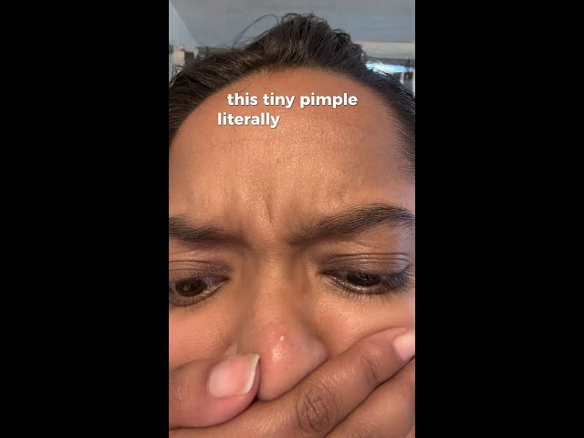 your go-to acne treatment for clear skin. 🩵