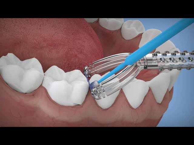 How To: Use SDFlosser®