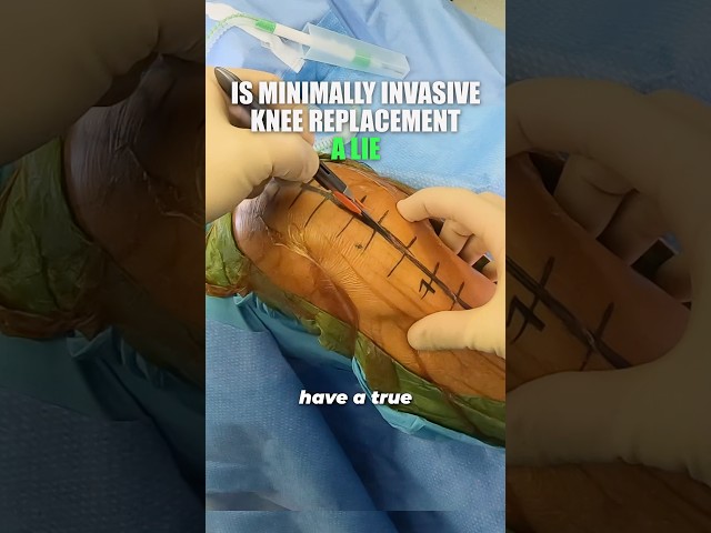 The Surprising Truth About Subvastus Knee Replacement Surgery