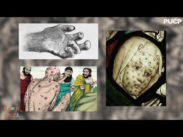 Historia de la ciencia: ¿Desde cuándo existe la lepra? - PUCP
