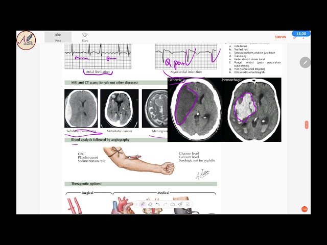 Complete STROKE - Classification, Pathophysiology, Siriraj Score, Gajah Mada, UKMPPD Practice Que...