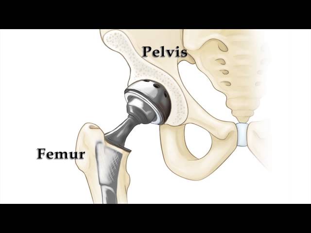 Dislocation After Total Hip Replacement