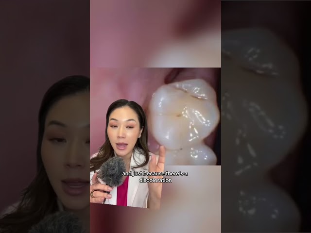 How to tell if you have a cavity. #cavity #cavities #dentist #selfexam