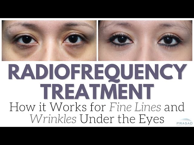 How Radiofrequency Devices Work on Fine Lines and Wrinkles, and Why it's Not the Only Treatment