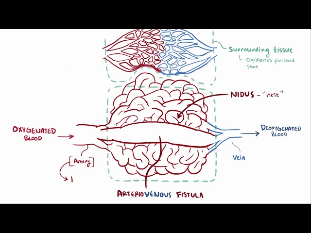 Arteriovenous malformation AVM   causes, symptoms, diagnosis, & pathology