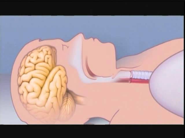 What Is Sleep Apnea?