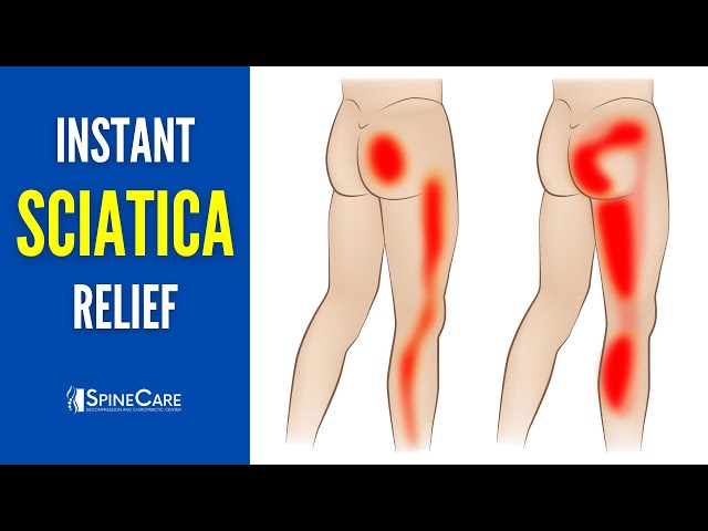 How to Fix Sciatica Pain in SECONDS