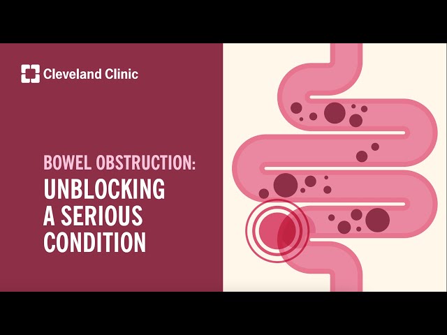 Bowel Obstruction: Unblocking A Serious Condition