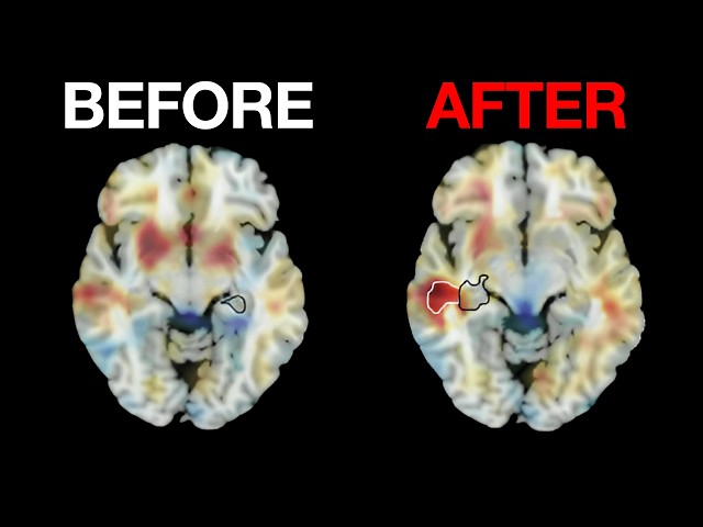 Long-Term Effect of Electroconvulsive Therapy (ECT) on the Brain
